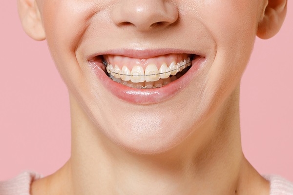 A Step-by-Step Process of How Braces Work - Brentwood Family ...