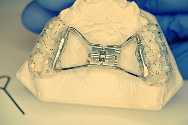 How A Palatal Expander Works